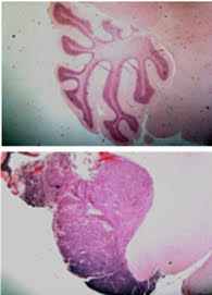 Histological analysis showing normal cerebellum and the extensive destruction caused by medulloblastoma