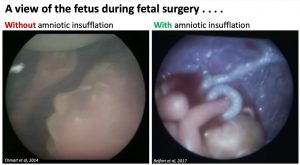 Image of fetal surgery, making it safer for babies with open spina bifida.
