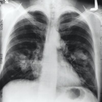 Lung x-ray Bronchopulmonary dysplasia (BPD)