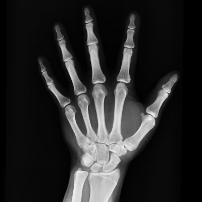 Osteoperosis xray of hand