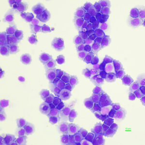 Immortalised AML cell line grown in the Leukaemia Modelling and Therapeutic Discovery lab