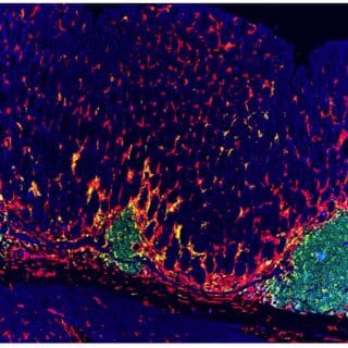 Tissue section from a pre-clinical model in which precancerous lesions of stomach lymphoma are seen to be predominantly composed of B cells (green) and surrounded by different types of immune cells (red, yellow). Image provided by Dr Ying.