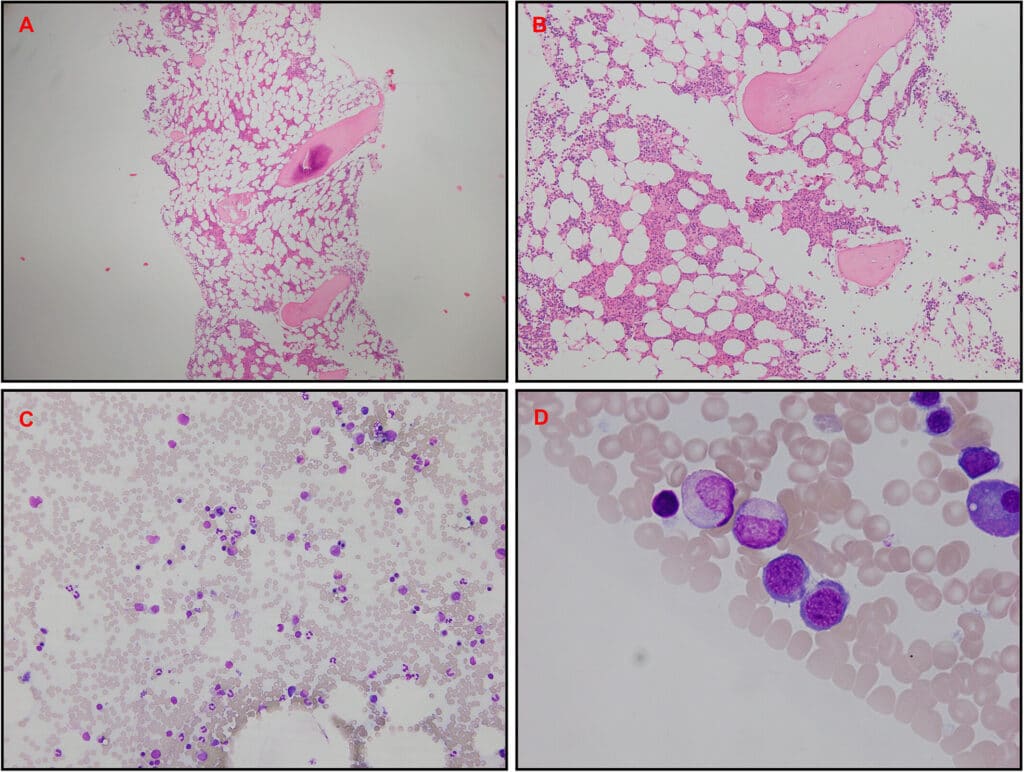 Bone marrow biopsy. (A and B) Hematoxylin and eosin trephine stain demonstrating mild to moderate hypocellular marrow (20%–30%) with moderately reduced erythropoiesis. (C and D) Aspirate demonstrating mild dyserythropoiesis with normal granulocytic and megakaryocytic lineages.