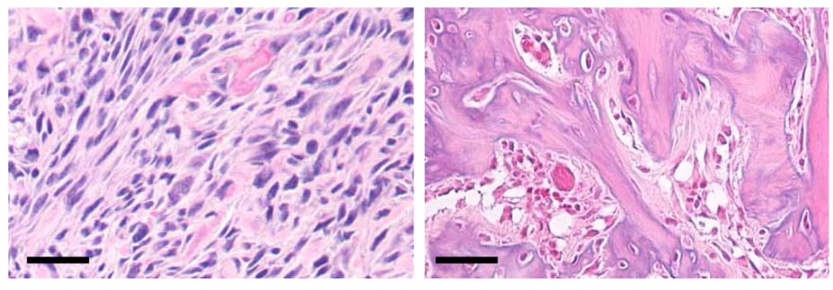 L pane - histopathology of untreated osteosarcoma, R panel - formation of mature bone in osteosarcoma in which the Hh signalling pathway has been inhibited