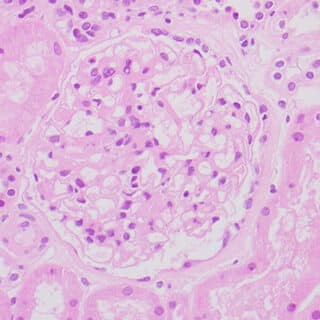 Renal biopsy. Hematoxylin and eosin stain demonstrating mild mesangial matrix expansion without significant capillary hypercellularity.
