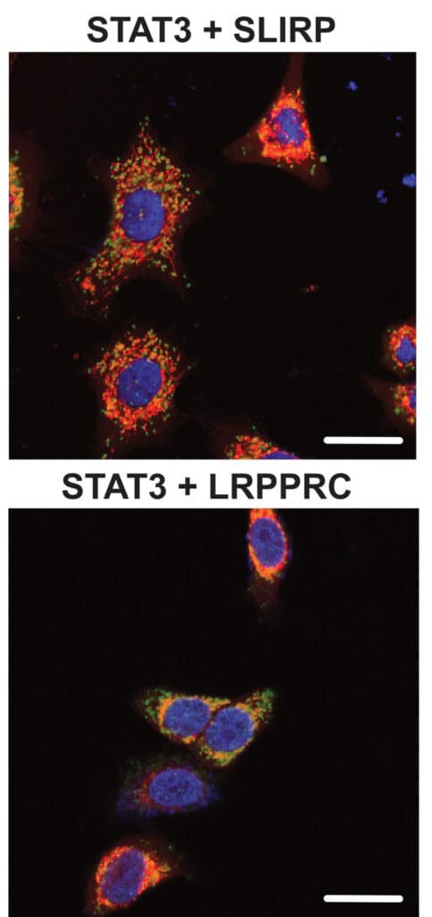 How cancer works | Cell image showing proximity ligation assay using antibodies against either LRPPRC and STAT3 or SLIRP and STAT3 (green), counterstained with DAPI (blue) and MitoTracker (red). Scale bar: 20 μm