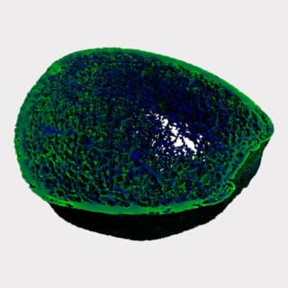 High-resolution peripheral quantitative computed tomography (HRpQCT) of the tibia demonstrating trabecular disruption and increased cortical porosity.