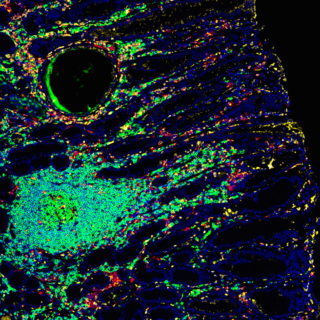Section of human stomach showing immune cells infiltrating the tissue